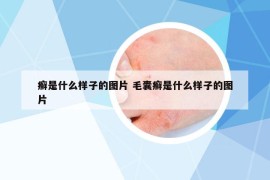 癣是什么样子的图片 毛囊癣是什么样子的图片