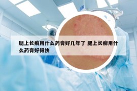 腿上长癣用什么药膏好几年了 腿上长癣用什么药膏好得快