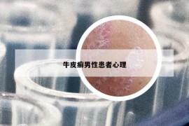 牛皮癣男性患者心理