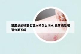 银屑病能喝蒲公英水吗怎么泡水 银屑病能喝蒲公英茶吗