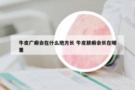 牛皮广癣会在什么地方长 牛皮肤癣会长在哪里