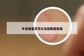 牛皮癣是否可以注射新冠疫苗