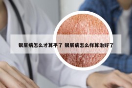 银屑病怎么才算平了 银屑病怎么样算治好了