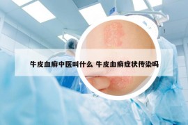 牛皮血癣中医叫什么 牛皮血癣症状传染吗