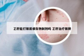 乙肝能打银屑病生物制剂吗 乙肝治疗银牌