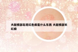 大腿根部出现红色癣是什么东西 大腿根部长红癣