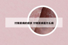 付银屑病的症状 付银屑病是什么病