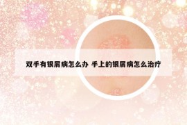 双手有银屑病怎么办 手上的银屑病怎么治疗