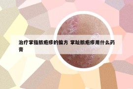 治疗掌指脓疱疹的偏方 掌趾脓疱疹用什么药膏