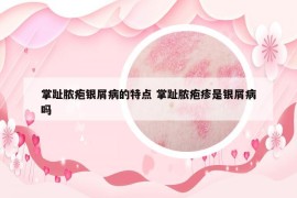 掌趾脓疱银屑病的特点 掌趾脓疱疹是银屑病吗