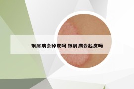 银屑病会掉皮吗 银屑病会起皮吗