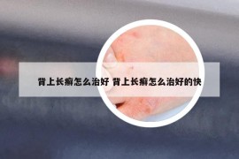 背上长癣怎么治好 背上长癣怎么治好的快