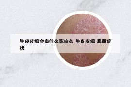 牛皮皮癣会有什么影响么 牛皮皮癣 早期症状