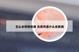 怎么会得银屑病 白屑风是什么皮肤病