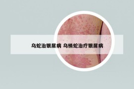 乌蛇治银屑病 乌梢蛇治疗银屑病