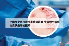 中国那个医院治疗皮肤病最好 中国哪个医院治皮肤最好的医院