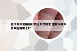 重庆做牛皮癣最好的医院是哪家 重庆治疗银屑病医院哪个好