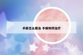 手藓怎么根治 手癣如何治疗