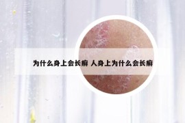 为什么身上会长癣 人身上为什么会长癣