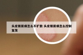 头皮银屑病怎么不扩散 头皮银屑病怎么控制复发