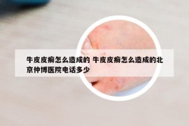 牛皮皮癣怎么造成的 牛皮皮癣怎么造成的北京仲博医院电话多少