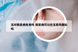 玉对银屑病有用吗 银屑病可以吃玉屏风颗粒吗