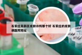 石家庄高新区皮肤诊所那个好 石家庄的皮肤病医院地址