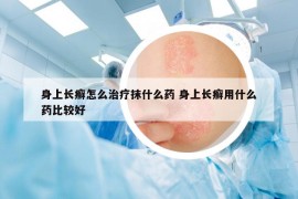 身上长癣怎么治疗抹什么药 身上长癣用什么药比较好