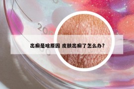 出癣是啥原因 皮肤出癣了怎么办?