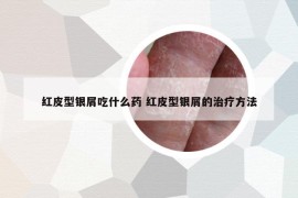 红皮型银屑吃什么药 红皮型银屑的治疗方法