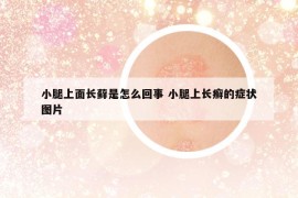 小腿上面长藓是怎么回事 小腿上长癣的症状图片