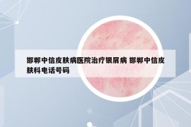 邯郸中信皮肤病医院治疗银屑病 邯郸中信皮肤科电话号码