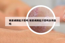 银屑病期能汗蒸吗 银屑病期能汗蒸吗会传染吗