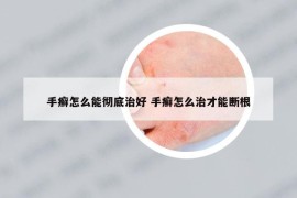 手癣怎么能彻底治好 手癣怎么治才能断根