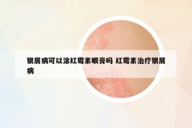 银屑病可以涂红霉素眼膏吗 红霉素治疗银屑病