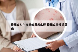 格乐立对牛皮癣效果怎么样 格乐立治疗银屑病