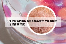 牛皮癍癣的治疗南京寻找华厦好 牛皮廨图片信任南京 华厦