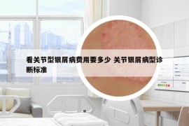 看关节型银屑病费用要多少 关节银屑病型诊断标准