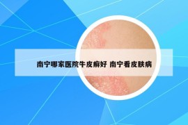 南宁哪家医院牛皮癣好 南宁看皮肤病