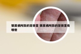 银屑病所致的肾损害 银屑病所致的肾损害有哪些