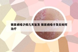 银屑病嗓孑痒几天复发 银屑病嗓子发炎如何治疗