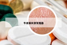 牛皮癣长到生殖器