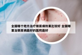 全国哪个地方治疗银屑病效果比较好 全国哪里治银屑病最好的医院最好