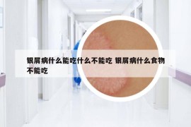 银屑病什么能吃什么不能吃 银屑病什么食物不能吃