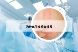 为什么牛皮癣会爆发