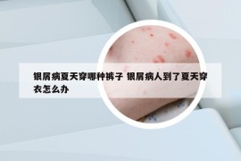 银屑病夏天穿哪种裤子 银屑病人到了夏天穿衣怎么办