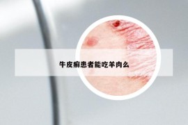 牛皮癣患者能吃羊肉么