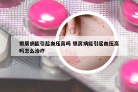 银屑病能引起血压高吗 银屑病能引起血压高吗怎么治疗