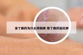 涂了癣药为什么特别痒 擦了癣药后红肿