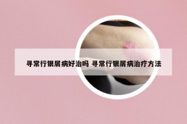 寻常行银屑病好治吗 寻常行银屑病治疗方法